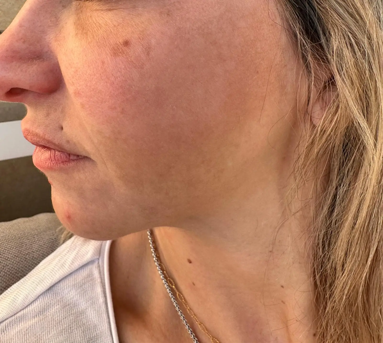 After Cosmelan treatment