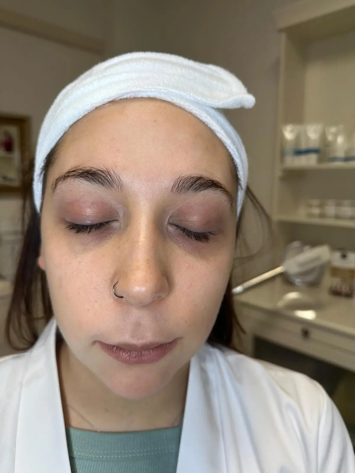 Before microneedling