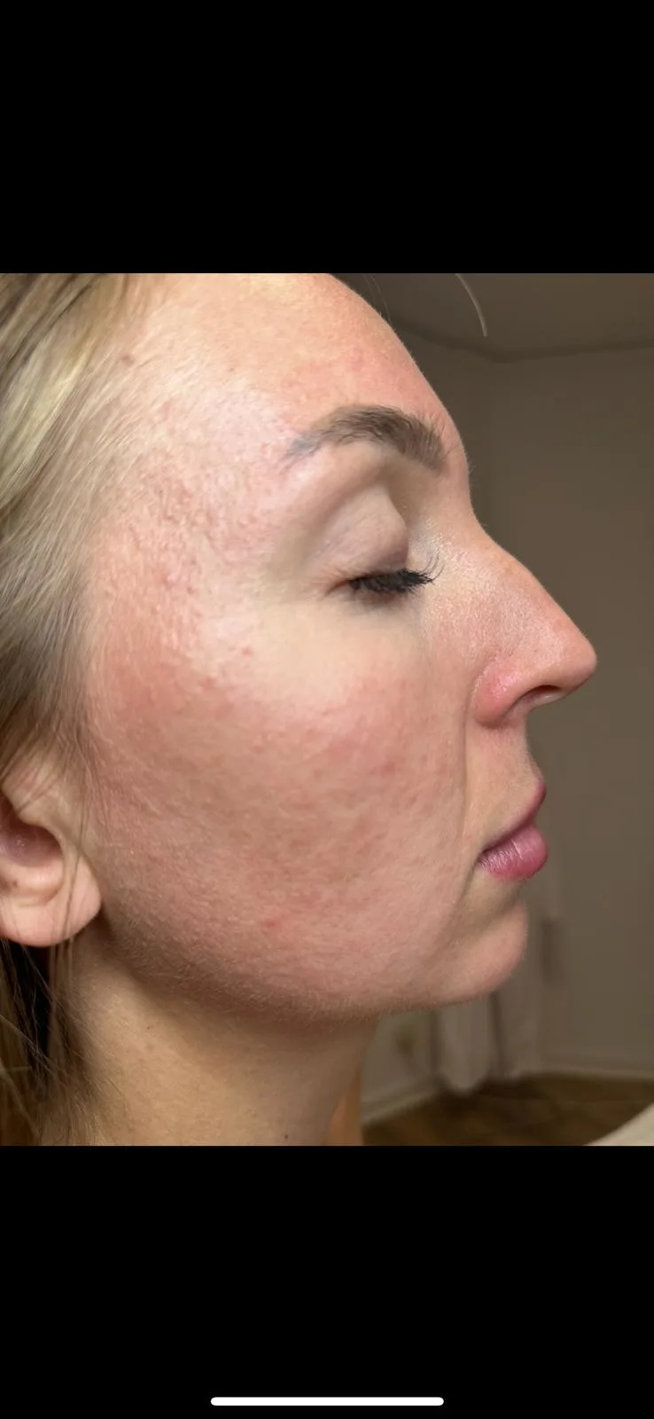 After chemical peel acne treatment