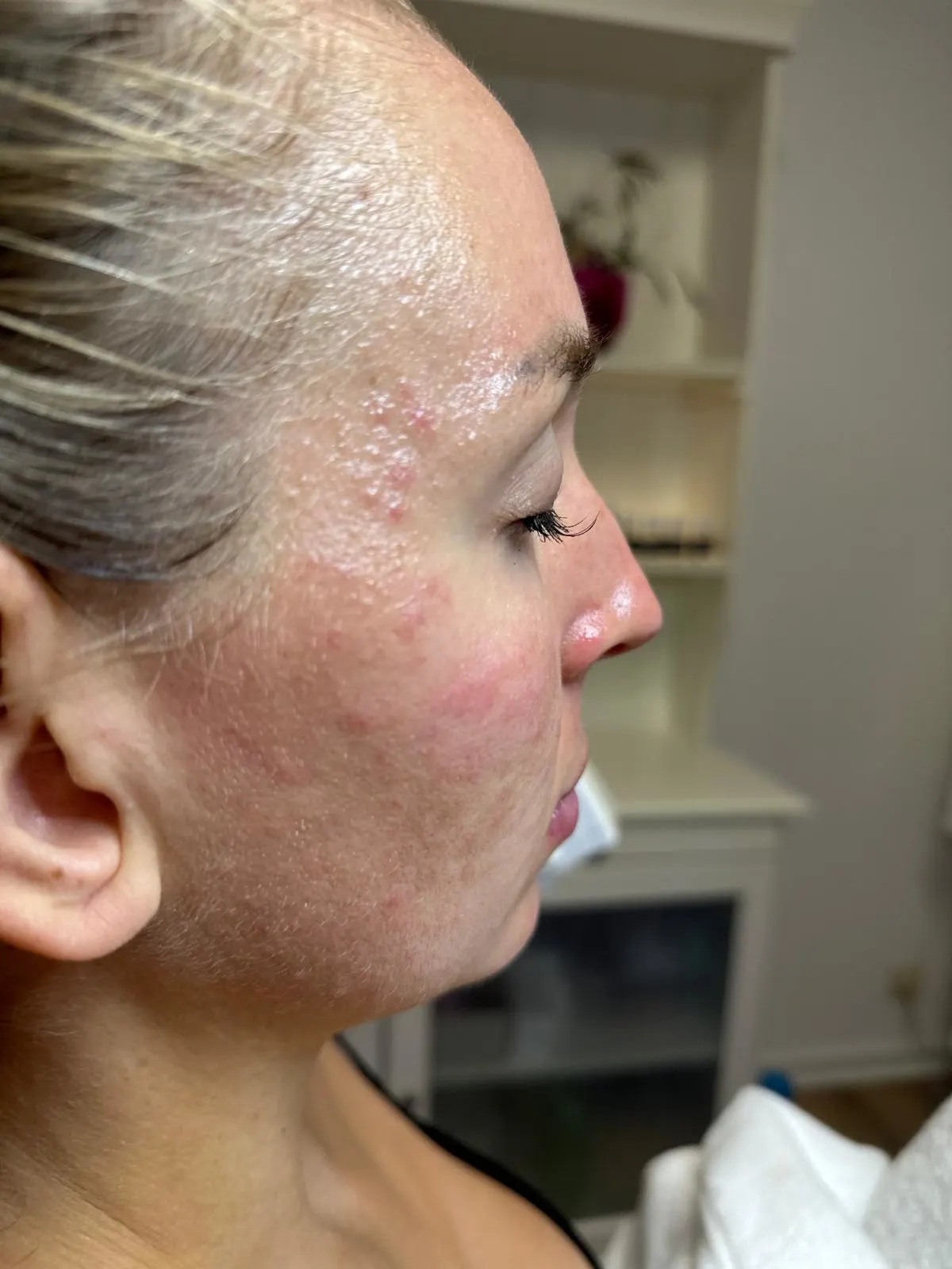 Before chemical peel acne treatment