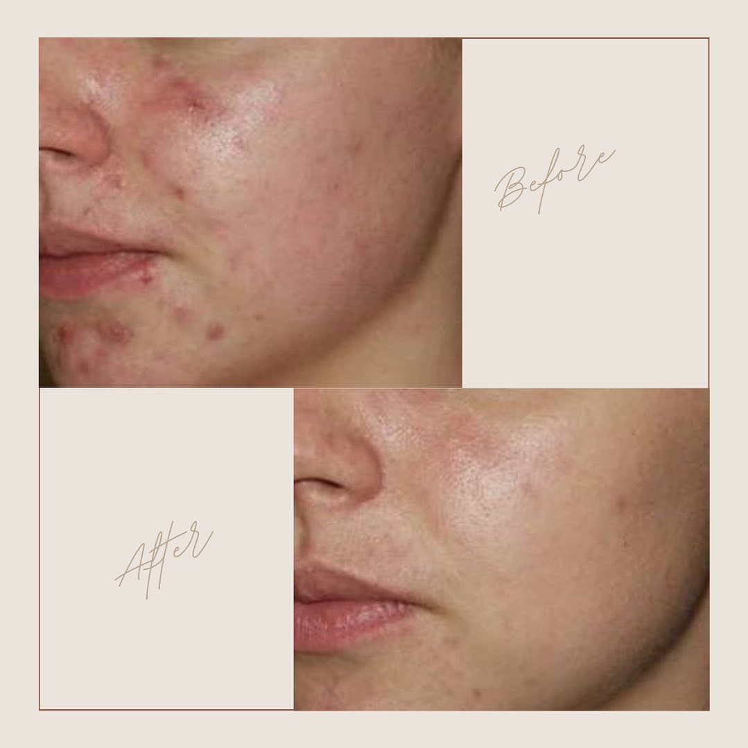 Peeling + Microneedling